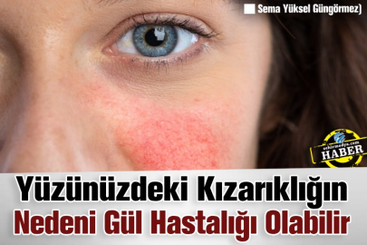 Yüzünüzdeki Kızarıklığın Nedeni Gül Hastalığı Olabilir